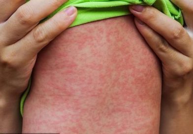 Ca mắc rubella vừa phát hiện ở Hà Nội đã tiêm vaccine